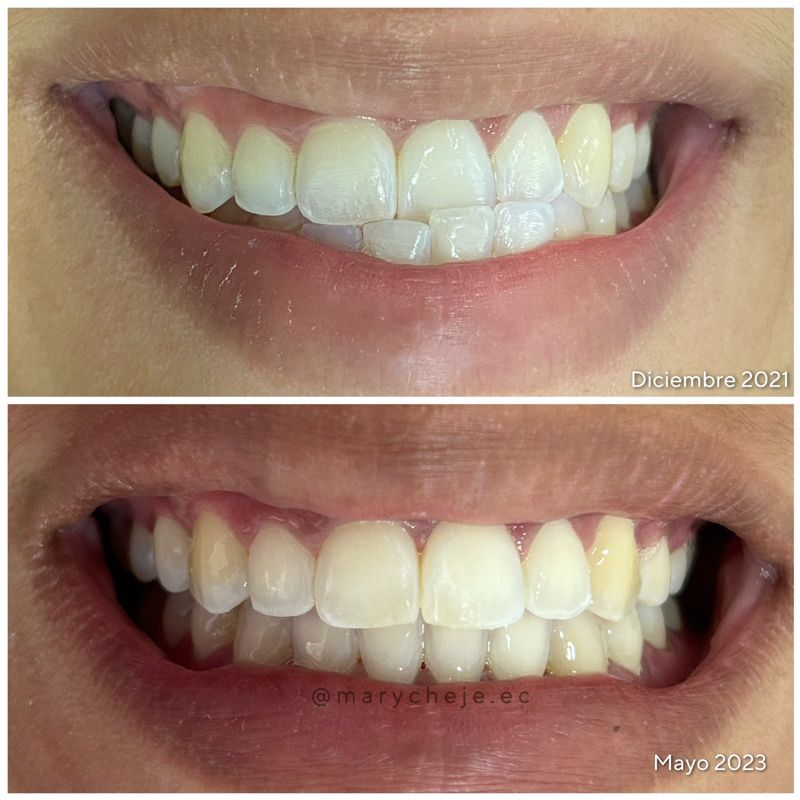 Sonrisa antes y después: diciembre de 2021 y mayo de 2023