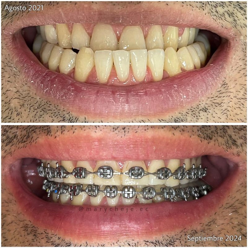 Sonrisa: agosto de 2021 y septiembre de 2024, con brackets