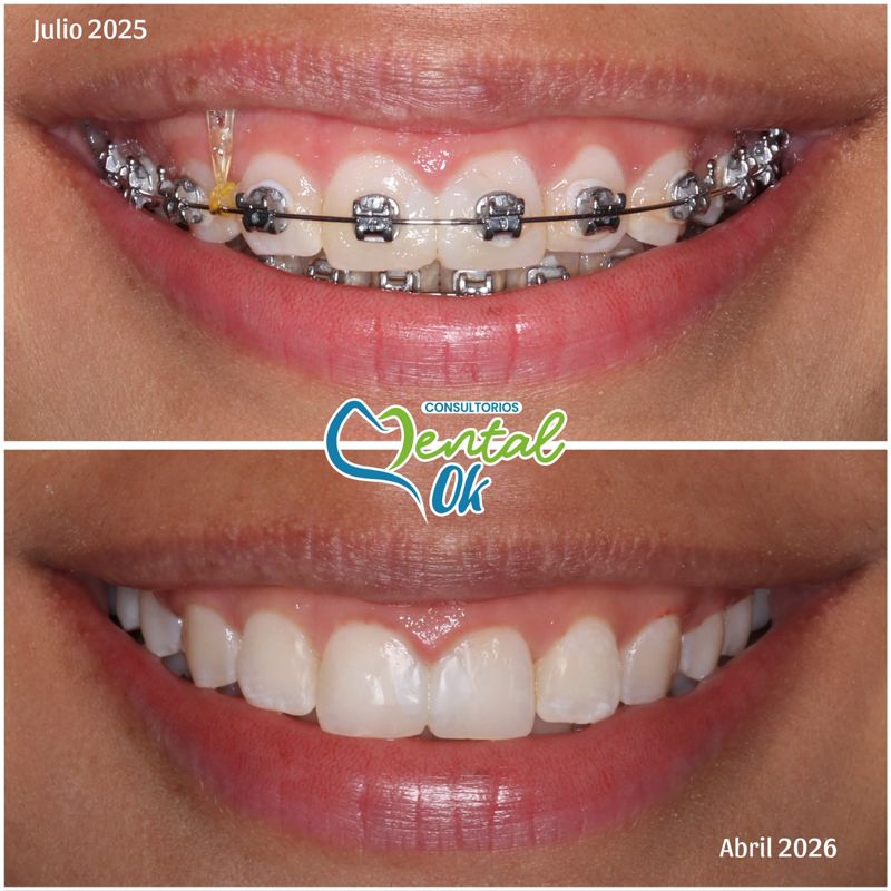 Sonrisa: julio de 2025 con brackets y abril de 2026 al terminar