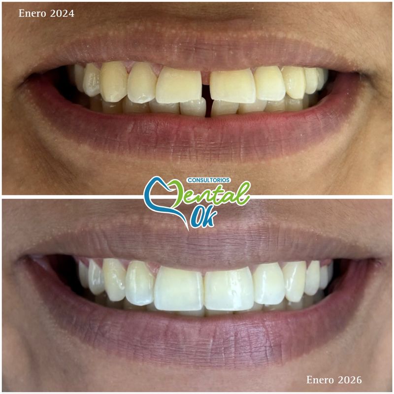 Sonrisa antes y después: enero de 2024 y enero de 2026