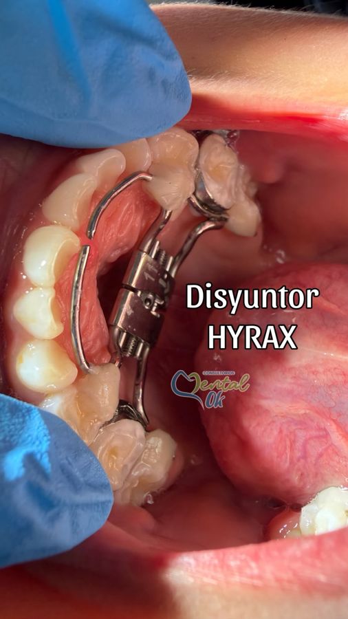 Disyuntor Hyrax instalado
