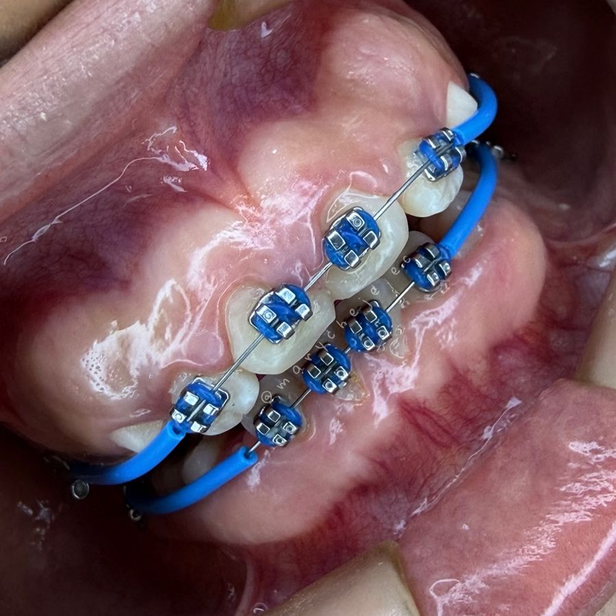 Brackets con ligas azules en tratamiento temprano