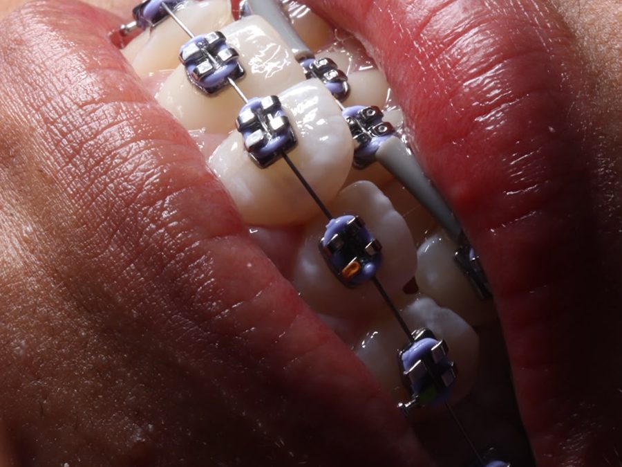 Brackets metálicos con ligas lila
