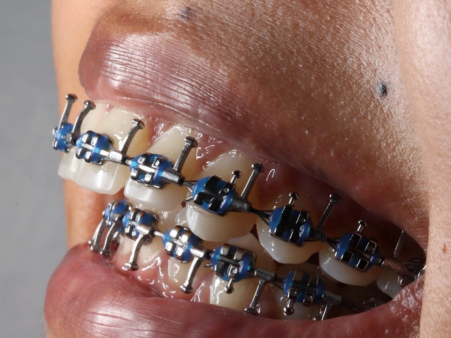 Brackets metálicos con arco quirúrgico