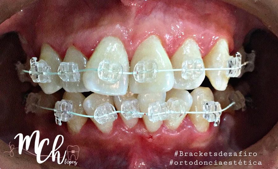 Brackets de zafiro instalados en arcada superior e inferior